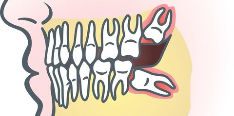 5 Tips on Recovering After Having Wisdom Teeth Removed Mark Stephens DMD Richmond (859)626-0069