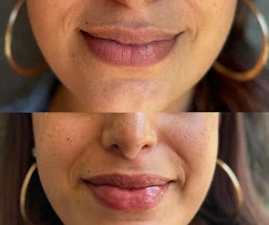 Before-and-after lip enhancement close-up.