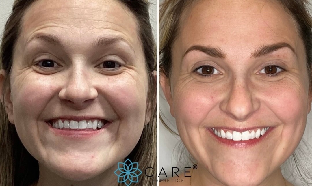 Before and after aesthetic results, Care Esthetics Delaware