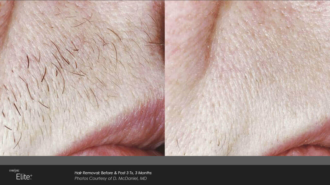 Images Onyx Esthétique - Soins esthétiques, Soins de la peau, Laser Cynosure Gatineau