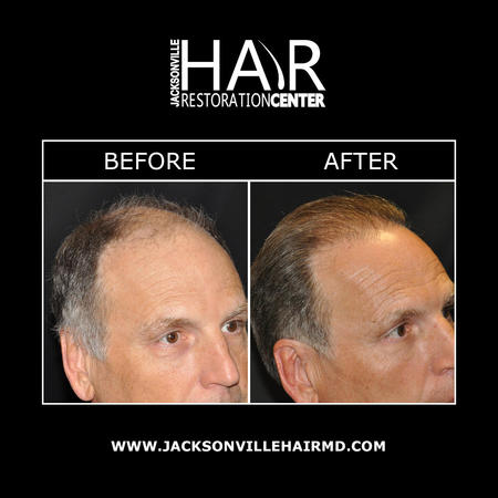 Jacksonville hair restoration uses advanced hair replacement techniques to help patients regrowth thicker, fuller hair. Using state-of-the-art technology, Dr. Bassin performs hair restoration to restore the hairline and improve overall hair volume and thickness. Hair restoration can provide natural-looking and long-lasting results.
