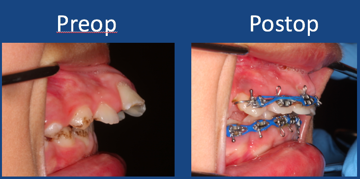 Before and After Orthognathic (Jaw) Surgery