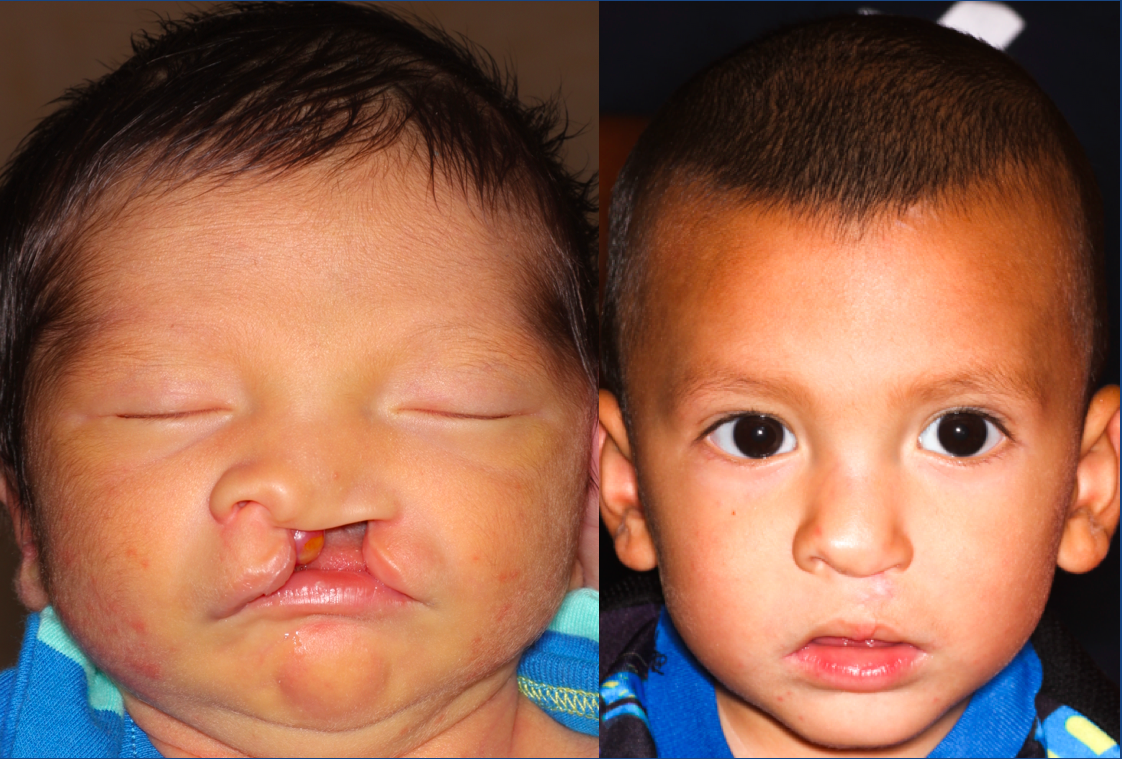 Before and After Unilateral Cleft Lip Repair