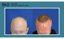 Images BKS Hair Restoration