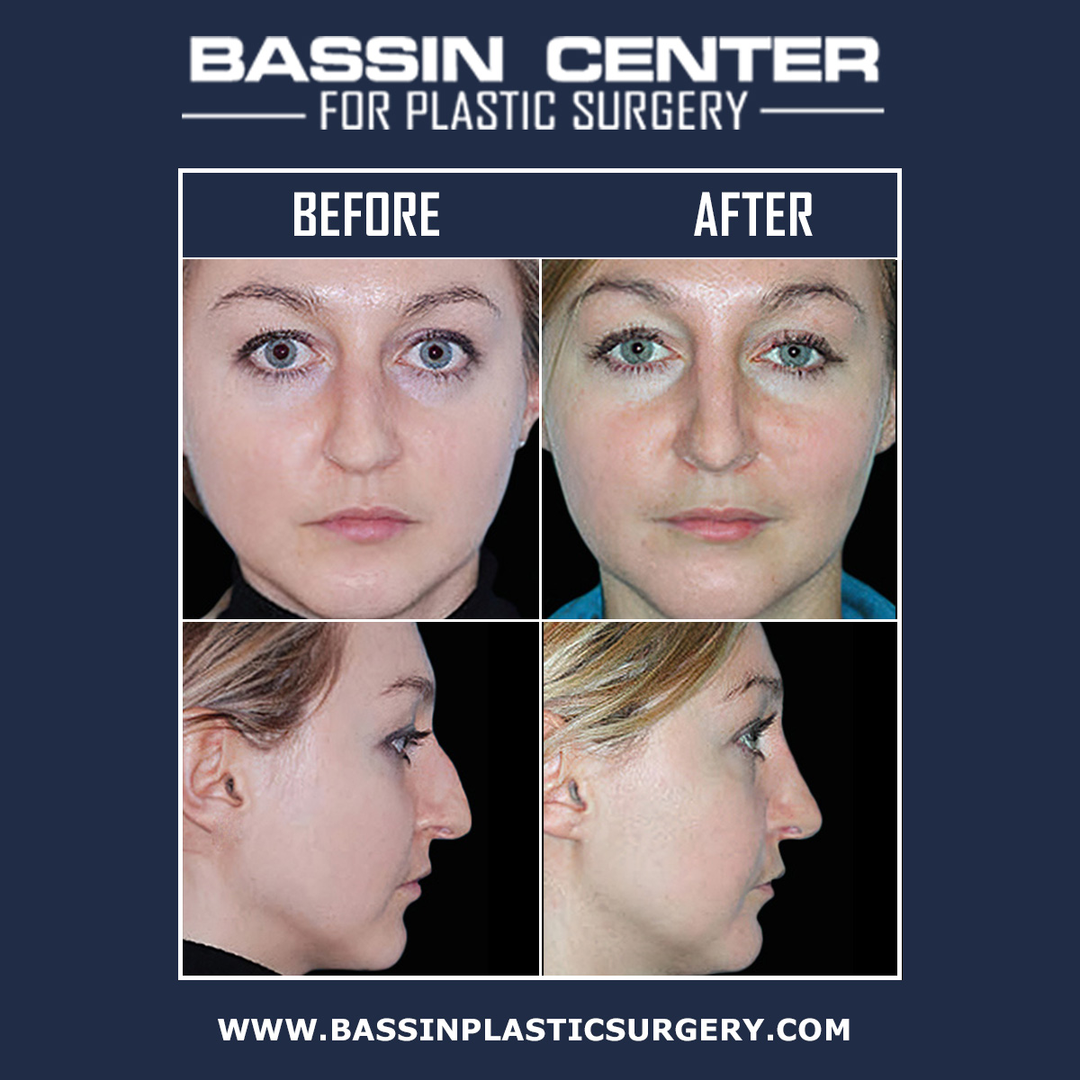 The Bassin Center For Plastic Surgery in Tampa offers rhinoplasty surgery for patients seeking to change the size or shape of their nose, balance the facial profile, or improve breathing problems. Achieve natural-looking results with nose surgery in Tampa.