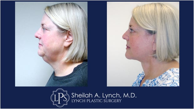 Images Sheilah A. Lynch, MD - Lynch Plastic Surgery