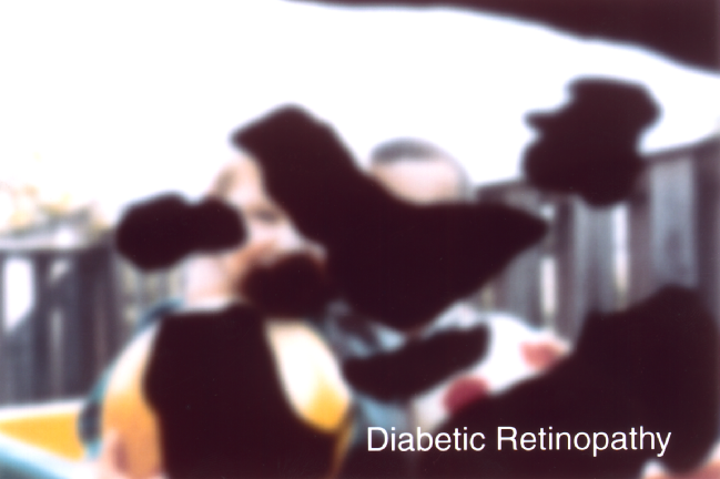 Dark floaters may indicate vitreous hemorrhage due to proliferative diabetic retinopathy or a retinal tear that could lead to retinal detachment.