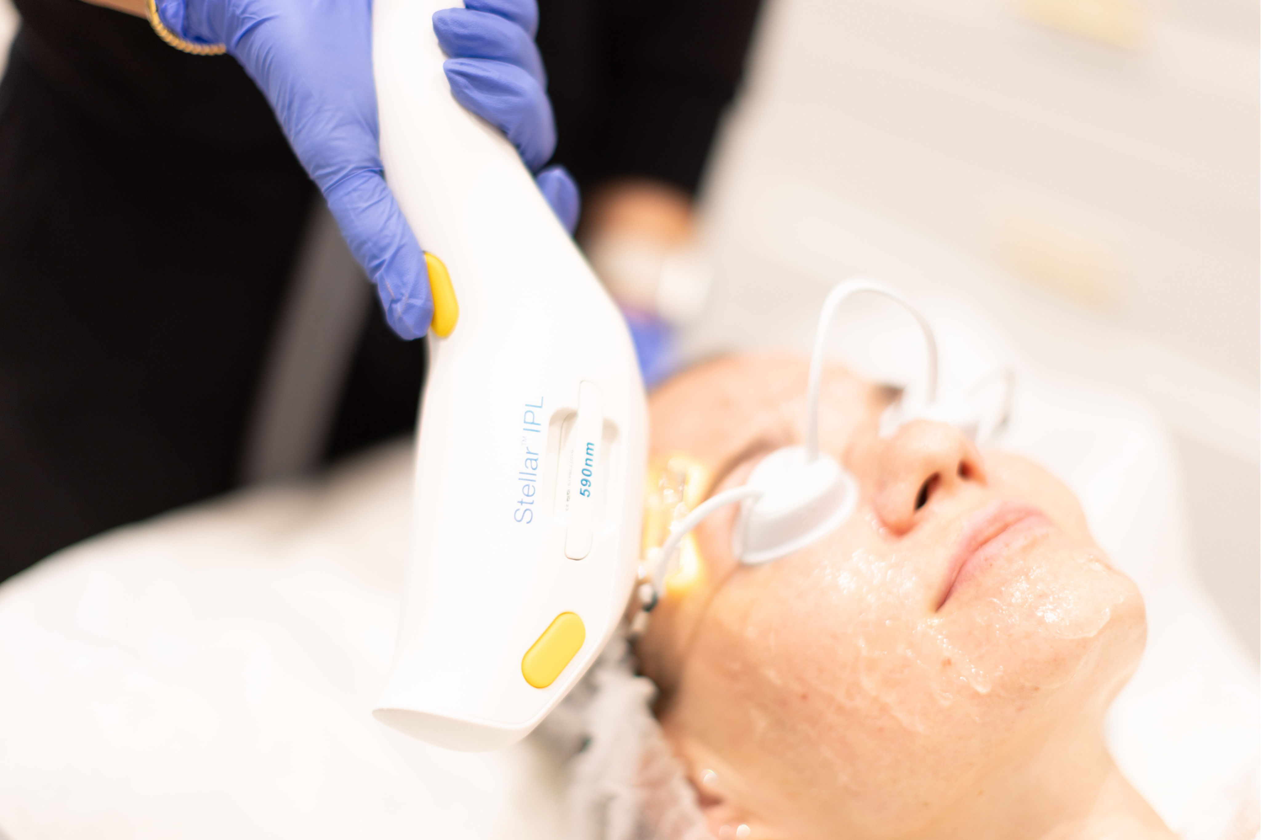 A Lumenis Stellar M22 Stellar IPL photofacial being performed at SVIT Aesthetics in Southlake, TX. T 