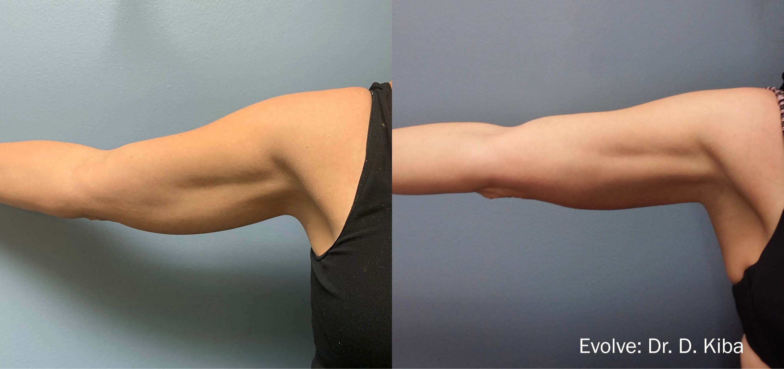 Before-and-after upper-arm body-contouring results showing reduced arm fullness and improved contour following a nonsurgical body-sculpting treatment at Grace MedSpa in Austin, Texas.