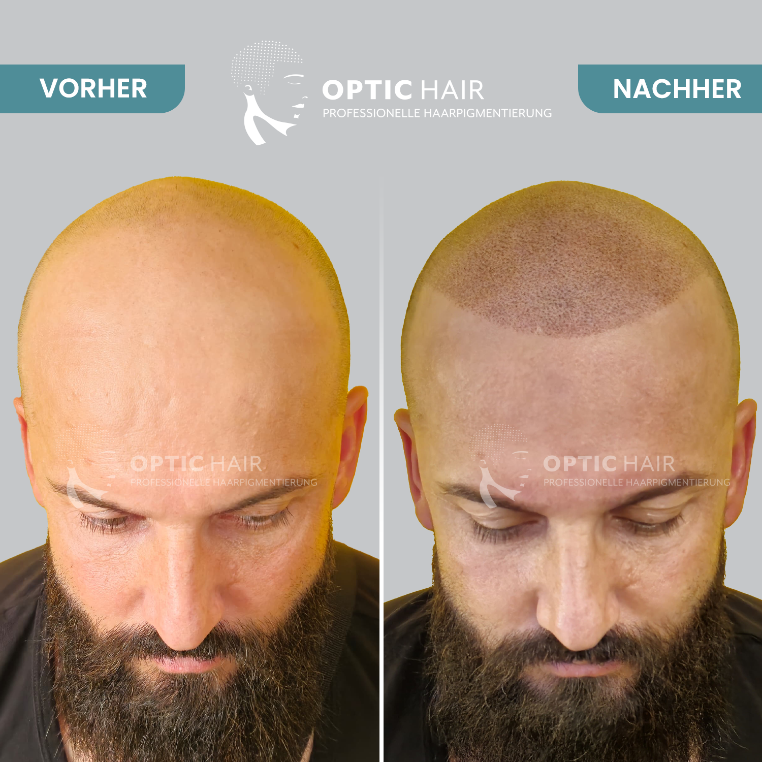 Kundenbild groß 2 Haarpigmentierung Köln | OpticHair