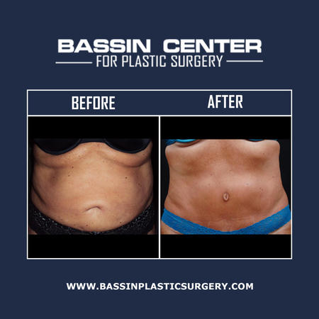 Body contouring can tighten lax skin & remove excess fat to enhance curves & achieve a firmer profile. Liposuction procedures can be used alongside a tummy tuck, arm lift, thigh lift, & buttocks augmentation to restore youthful-looking contours. Additionally, natural fat grafting using NaturalFill® can replenish long-lasting volume using your body’s own fat cells.
