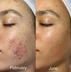 Acne-prone skin before-and-after progress (February to June).