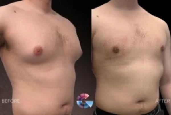 Images Gynecomastia Surgery Center in Los Angeles