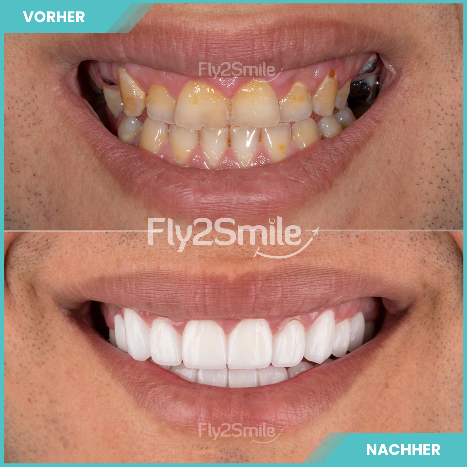 Kundenbild groß 11 Veneers & Zahnimplantate – Zähne machen lassen in der Türkei mit Fly2Smile
