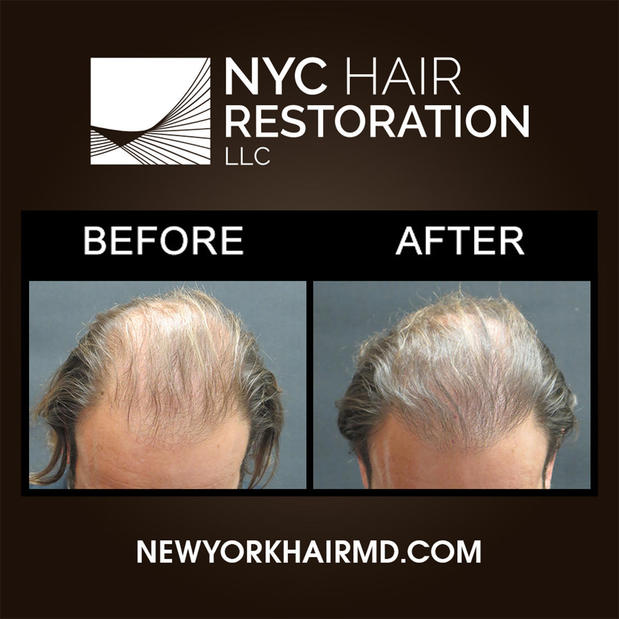 Images NYC Hair Restoration