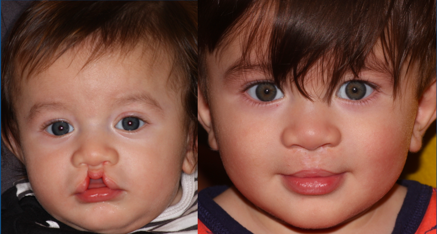 Before and After Bilateral Cleft Lip Repair