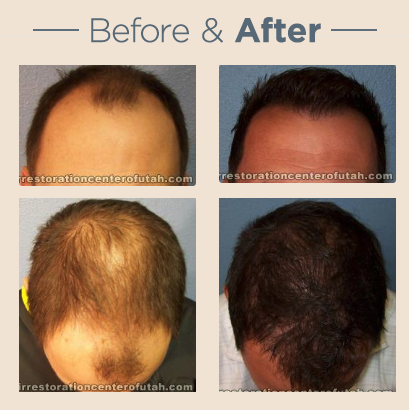 Images Hair Restoration Center of Utah