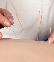 Image 3 | Enmunity Acupuncture