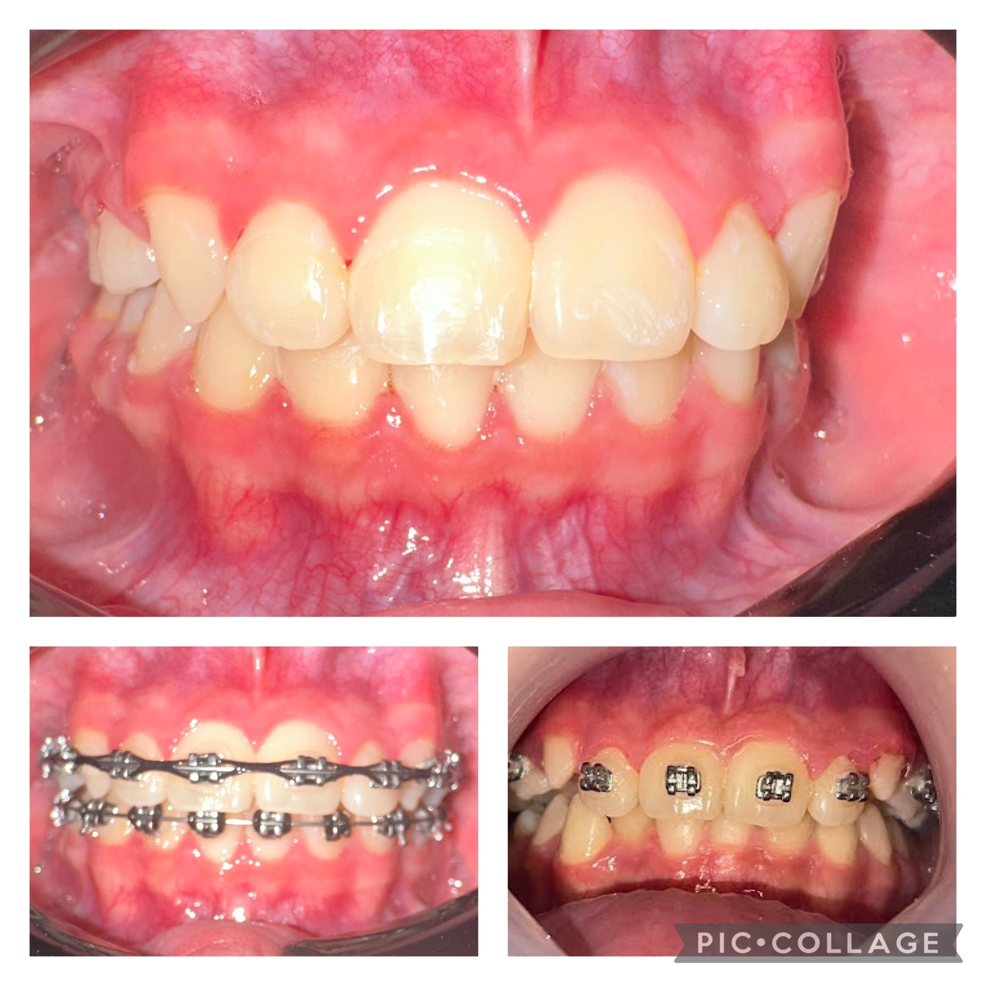 Cortes Family Dentistry- Brackets