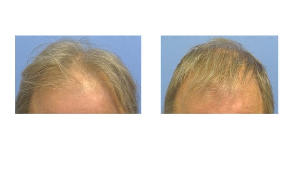 Images Hair Restoration Institute of the Hudson Valley