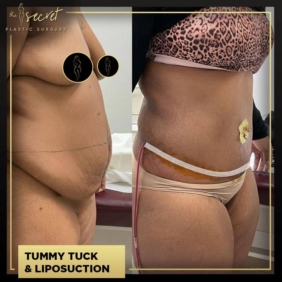Tummy Tuck - The Secret Plastic Surgery