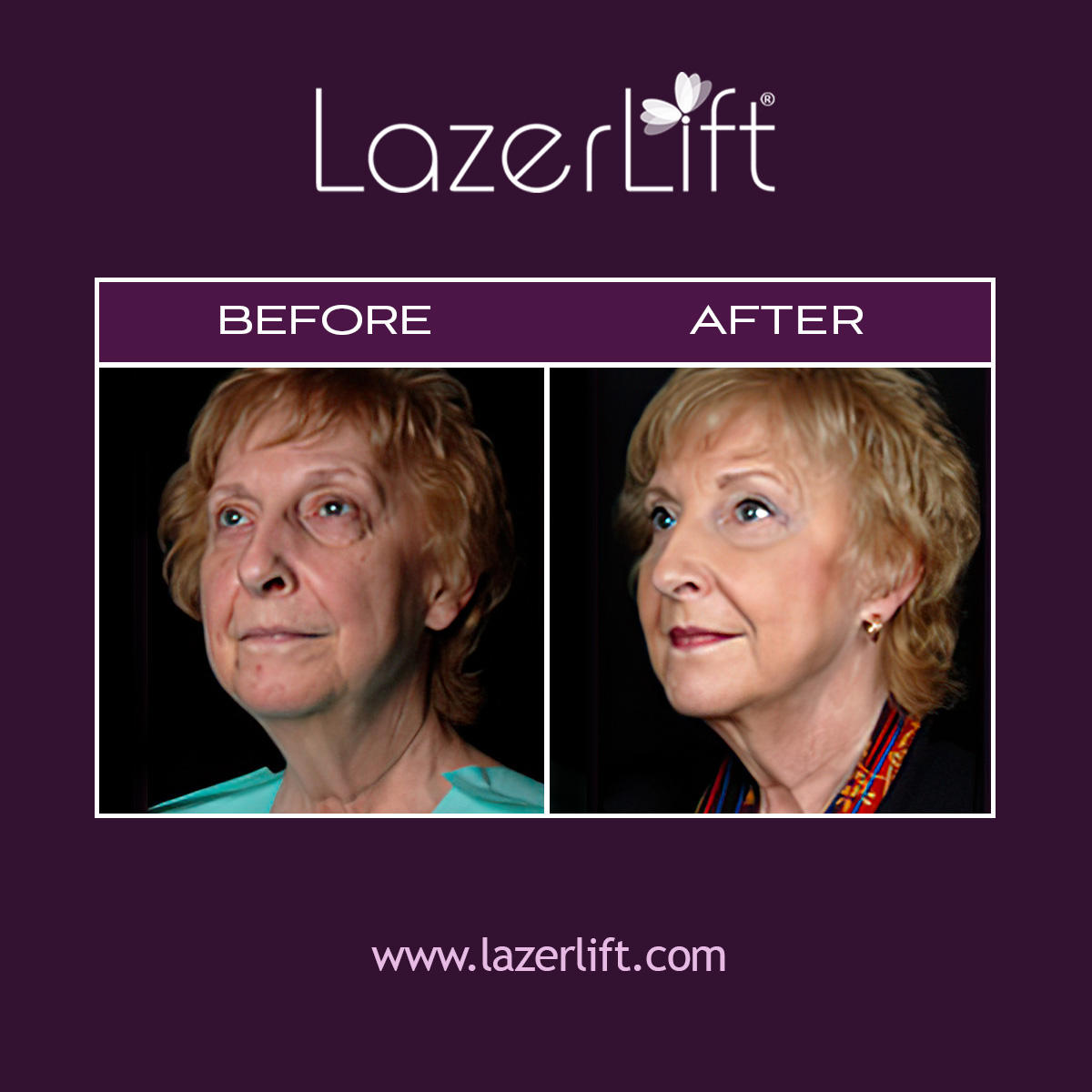 LazerLift® turns back the clock on facial aging. This Tampa facelift uses laser technology to tighten and lift the skin. LazerLift® provides an alternative to facelift surgery. It is minimally invasive and is completed in less than an hour.