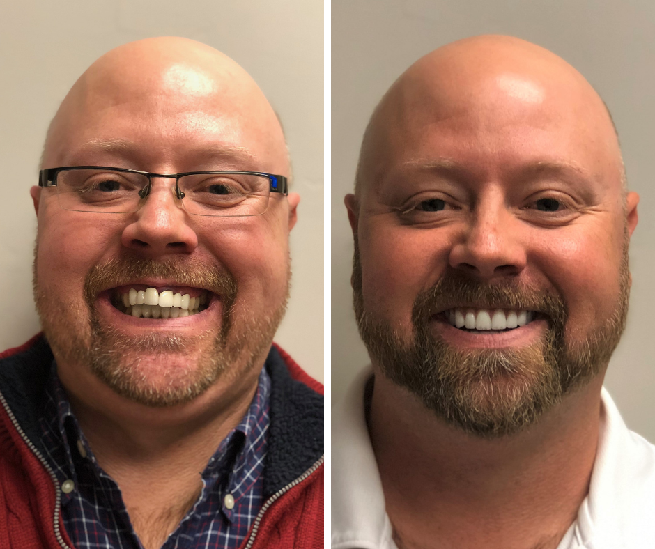 Before and After from Stubbs Dental | Layton, UT