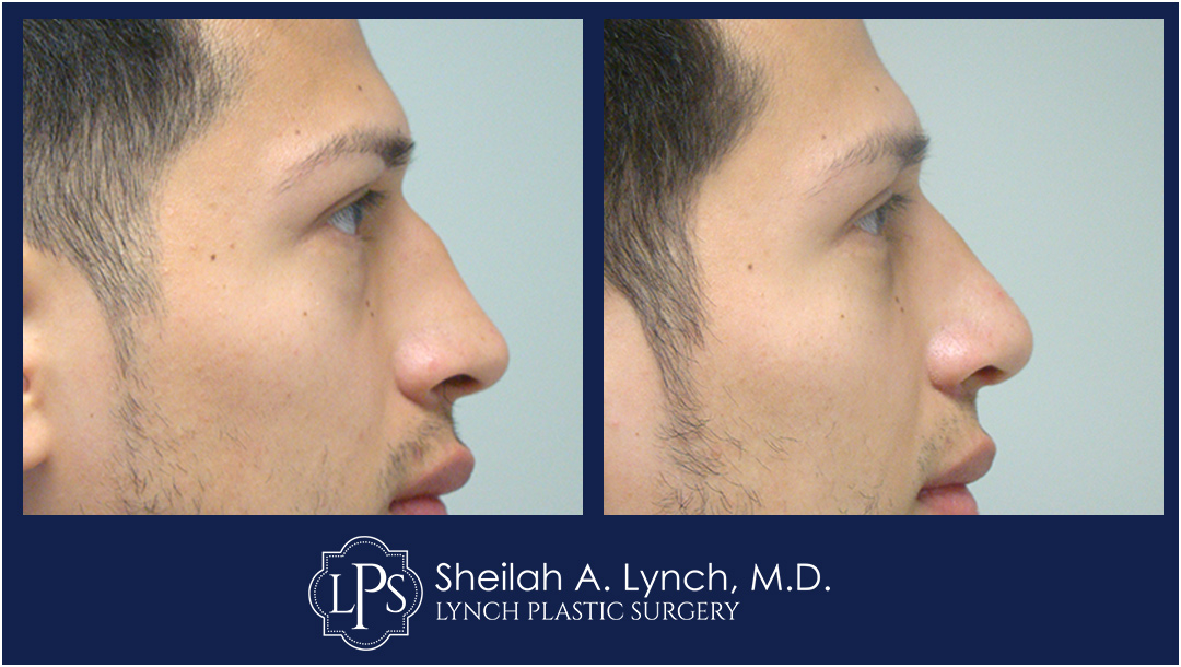 Male Rhinoplasty, Nose Reshaping Before & After Patient Chevy Chase Maryland. Plastic Surgeon Near Me Sheilah A. Lynch, MD
