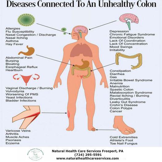 Diseases connected to an unhealthy colon are
Diverticulitis: Small pouches form and become inflamed or infected.
Irritable Bowel Syndrome (IBS): A disorder causing abdominal pain and bowel changes.
Ulcerative Colitis: Inflammation and ulcers form in the lining of the large intestine.
Colon Cancer: Malignant cells form in the tissues of the colon.
Crohn's Disease: A type of inflammatory bowel disease that may affect any part of the gastrointestinal tract.
Constipation: Infrequent bowel movements or difficult passage of stools.
Colonic Polyps: Growth on the inner surface of the colon, which can become cancerous.
Gastroenteritis: Inflammation of the stomach and small intestine.
Celiac Disease: Autoimmune disorder where gluten ingestion leads to damage in the small intestine.
Hemorrhoids: Swollen veins in the lowest part of the rectum and anus.
