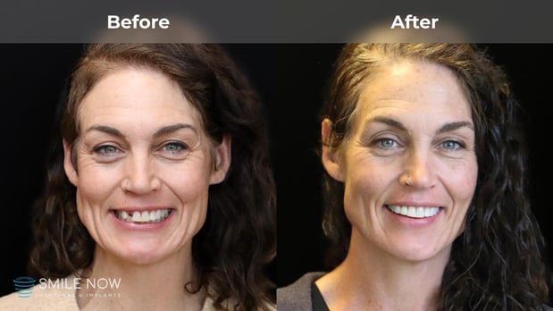 Images Smile Now Milwaukee Dentures and Implants