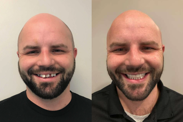 Before and After from Stubbs Dental | Layton, UT