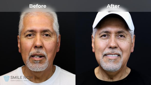 Images Smile Now Milwaukee Dentures and Implants