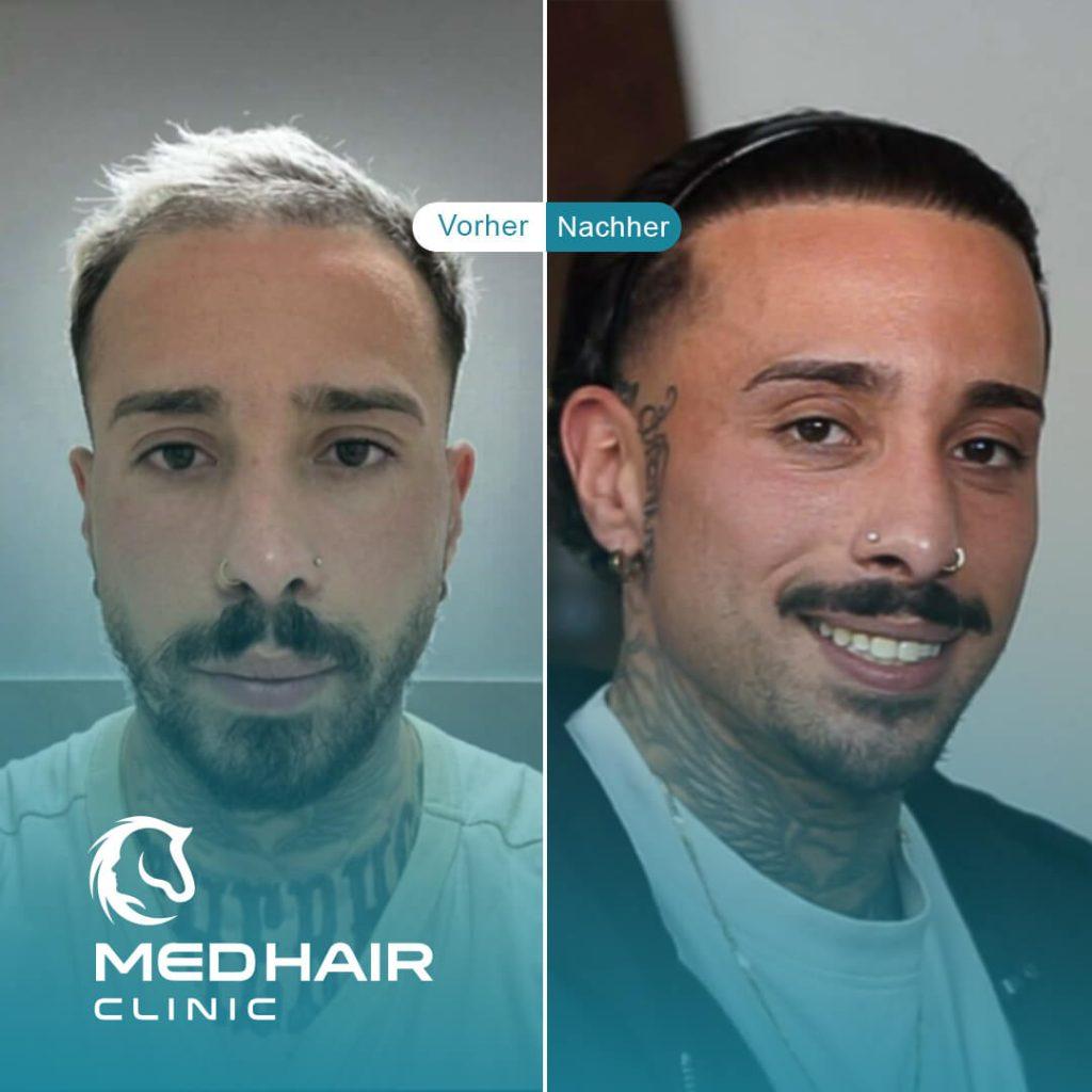 MedHair Clinic | Haartransplantationen in der Türkei Istanbul, Höninger Weg 176 in Rodenkirchen