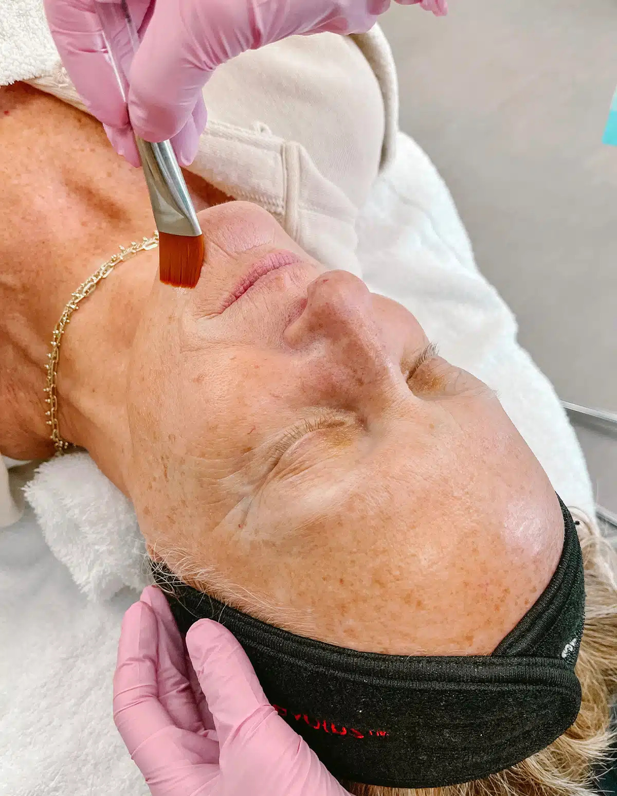 Chemical peel