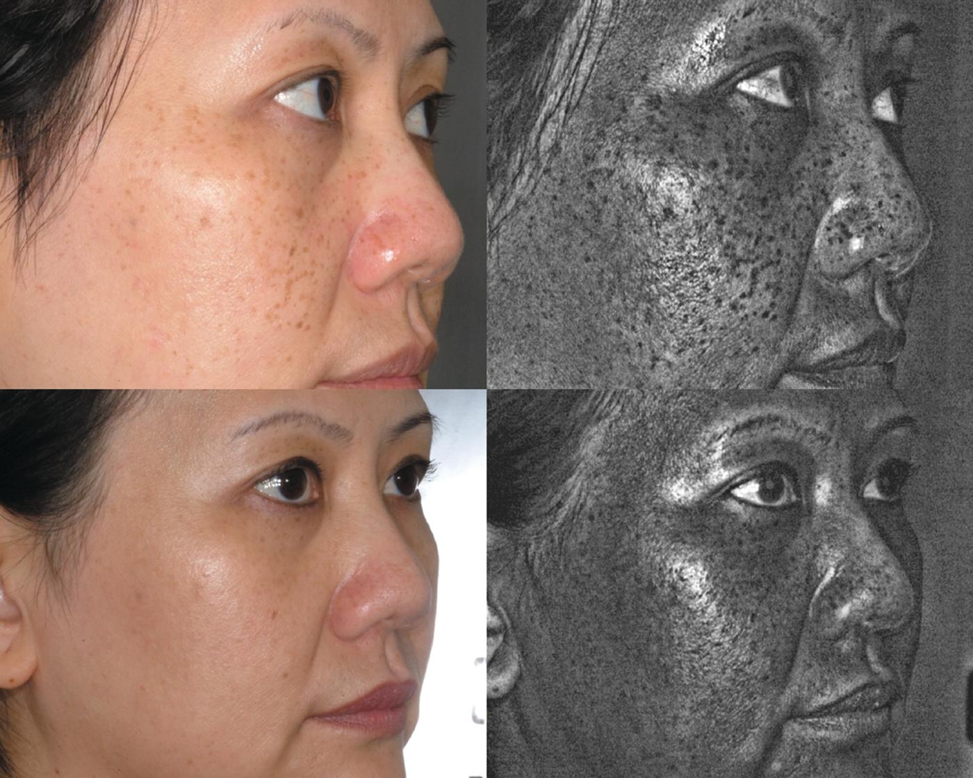 IPL (intense pulsed light) treatment of age spots in Asian Skin