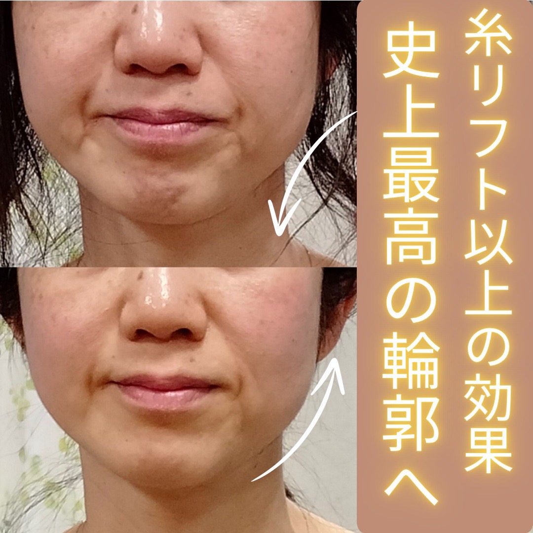 Images 目元・口元のたるみ&眉間シワ改善専門サロン