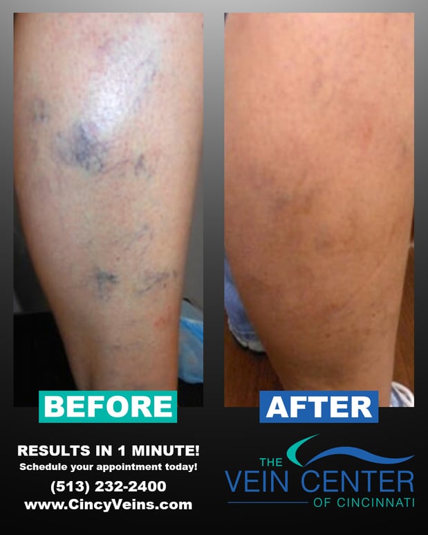 Images The Vein Center of Cincinnati, LLC