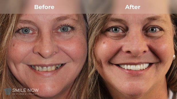 Images Smile Now Milwaukee Dentures and Implants