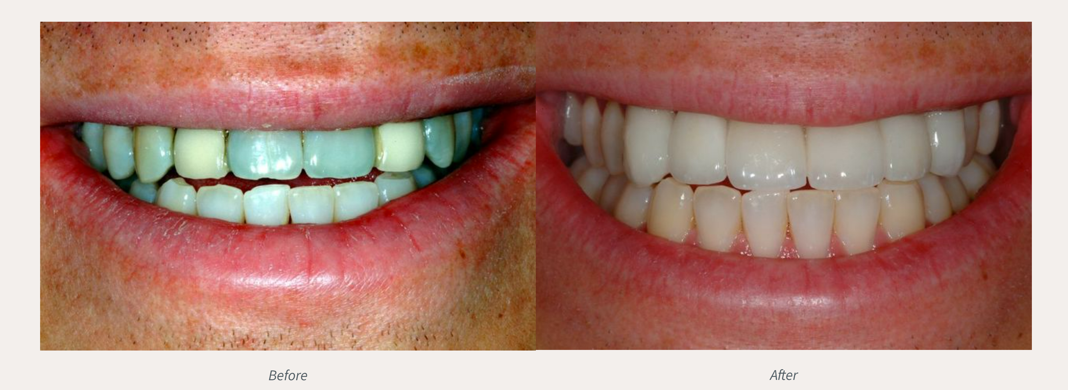 Dental Crowns Before & After from Advanced Dental Care | Valdosta, GA