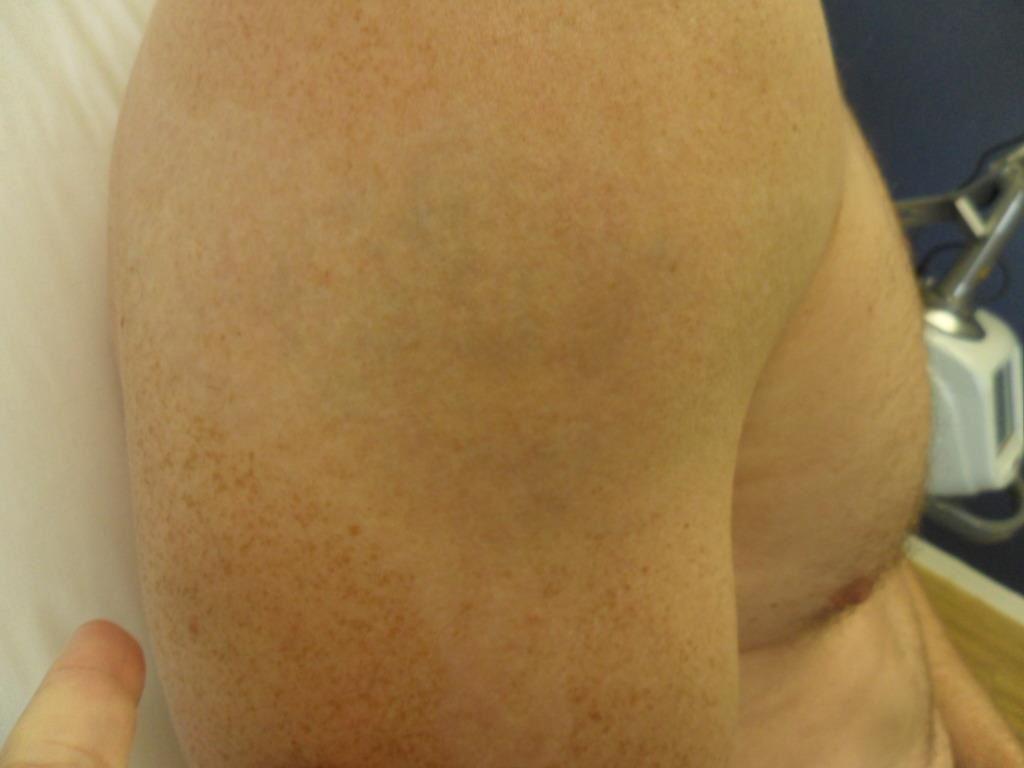 medermis laser tattoo removal in san antonio tx 78258 medermis laser tattoo removal in san antonio tx 78258