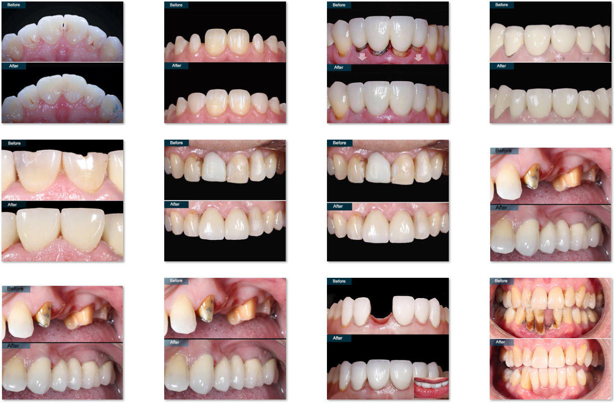 Cosmetic Dentistry Before and After