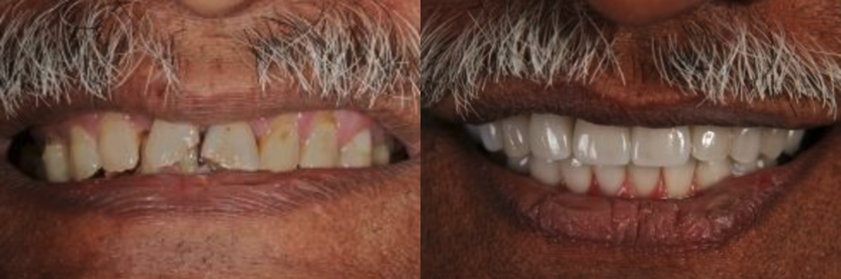 Crowns Before & After at Schmitt Prosthodontics | Altamonte Springs, FL
