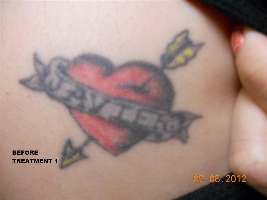 MEDermis Tattoo Removal in Austin, TX 78704 