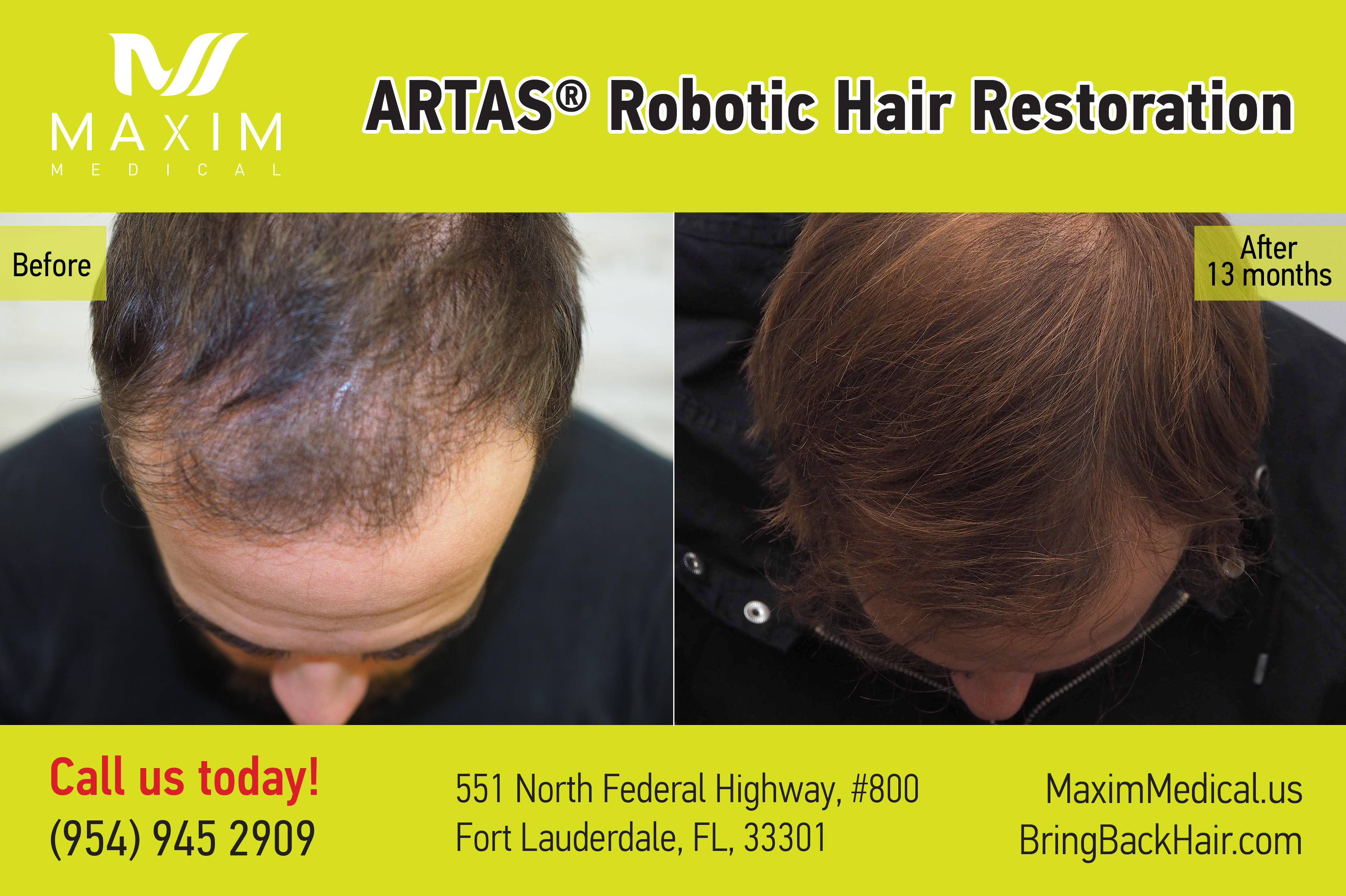 ARTAS Robotic Hair Transplant at Maxim Medical, Fort Lauderdale