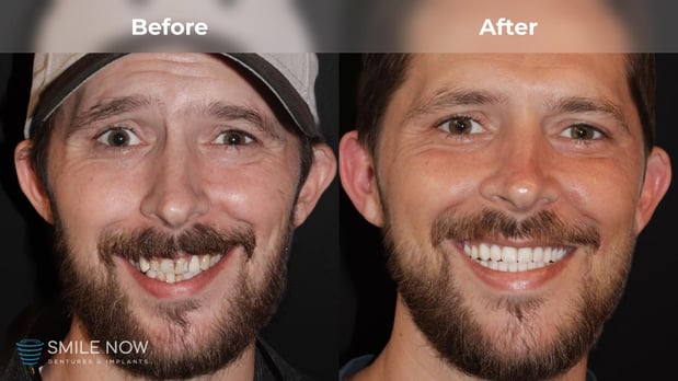 Images Smile Now Milwaukee Dentures and Implants
