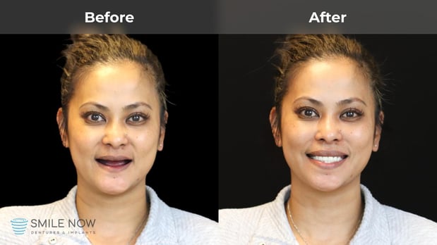 Images Smile Now Milwaukee Dentures and Implants