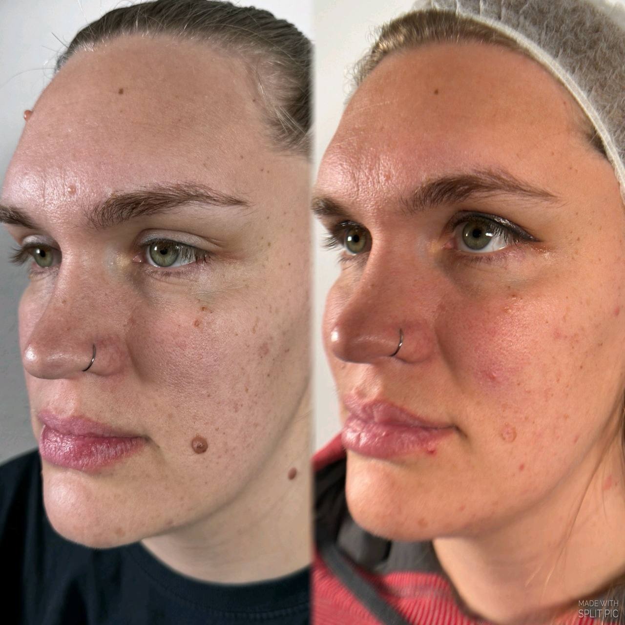 Facial and body mole and wart removal in Colorado Springs by Marysol Gill, designed to safely improve the appearance of unwanted skin growths, raised moles, and visible blemishes for smoother, clearer-looking skin. A professional skin treatment for clients seeking mole removal, wart removal, and cosmetic skin refinement with a personalized approach.