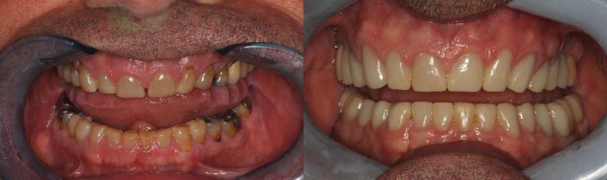 Before & After from Alafaya Family Dentistry | Oviedo, FL