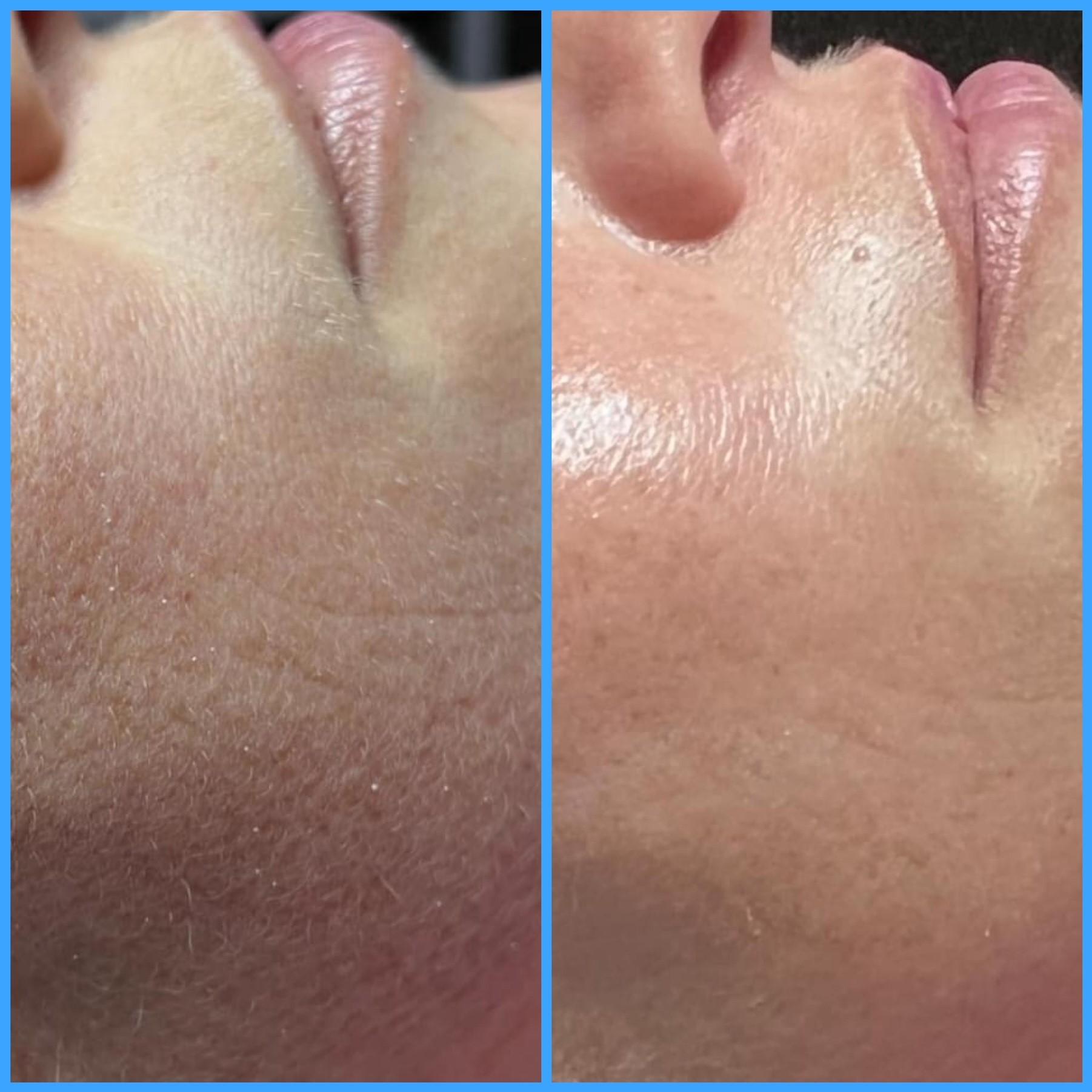 Skin rejuvenation before after in Scottsdale