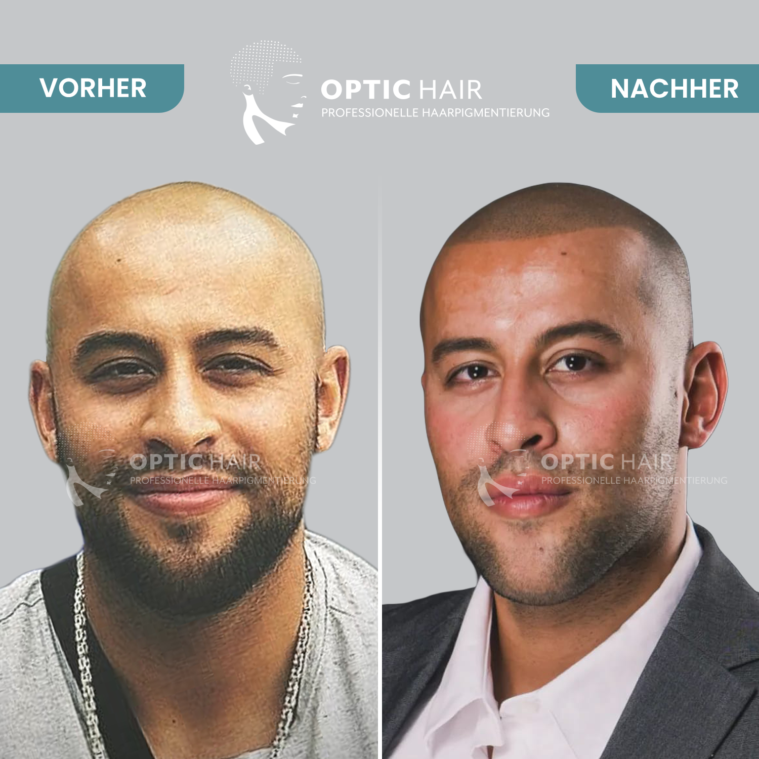 Kundenfoto 40 Haarpigmentierung Köln | OpticHair